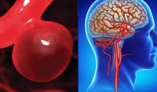 Người đàn ông bị đột quỵ xuất huyết não trong đêm thừa nhận thường xuyên làm việc này