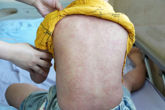 Bé trai đau bụng suốt 3 ngày, bố mẹ bất ngờ khi bác sĩ báo lý do