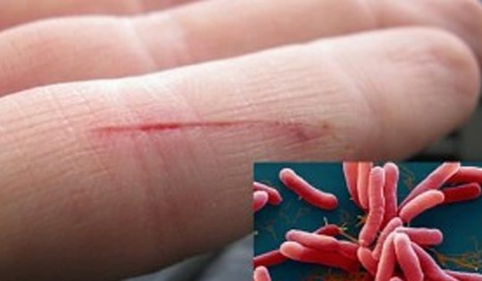 Người đàn ông 52 tuổi ở Lào Cai nhiễm vi khuẩn 'ăn thịt người' Whitmore khi dọn bùn sau lũ