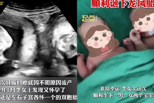 Người phụ nữ sinh hai con từ hai tử cung