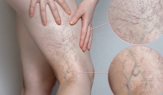 6 yếu tố làm tăng nguy cơ suy giãn tĩnh mạch chân