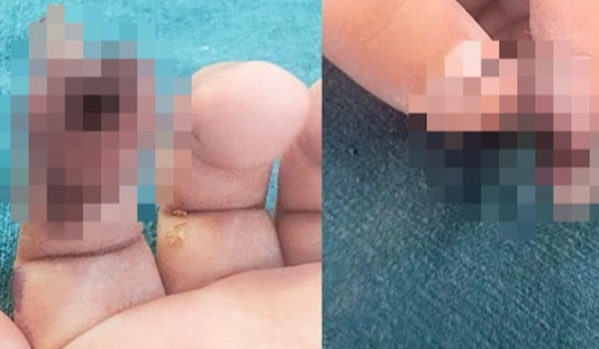 Bé gái 3 tuổi ở Hà Nội đứt rời búp ngón tay do kẹp vào cửa kính ở siêu thị