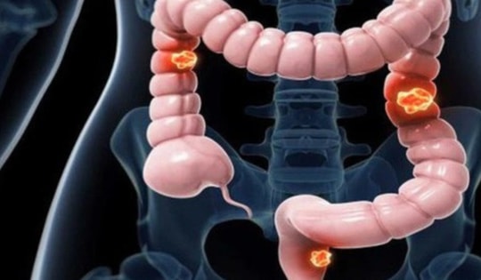 Người đàn ông 50 tuổi mắc ung thư đại trực tràng thừa nhận thường xuyên làm việc này