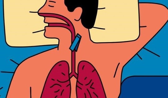 Biểu hiện mắc hội chứng ngưng thở khi ngủ