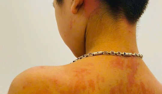 Trẻ 7 tuổi ở Hà Giang sốc phản vệ vì thói quen nhiều cha mẹ Việt hay làm mỗi khi bị ho