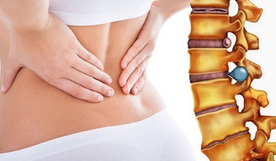 Khi nào cần phẫu thuật thoát vị đĩa đệm?