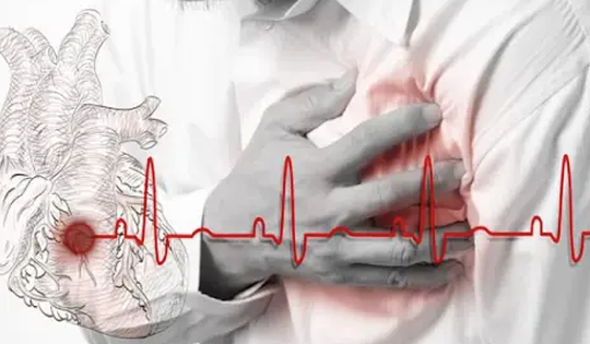 Rung nhĩ và các bệnh lý tim mạch làm tăng nguy cơ đột quỵ gấp 5 lần