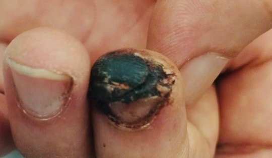 Người đàn ông 49 tuổi ở Bắc Ninh nguy kịch, tiên lượng tử vong cao từ vết thương hở ở ngón tay