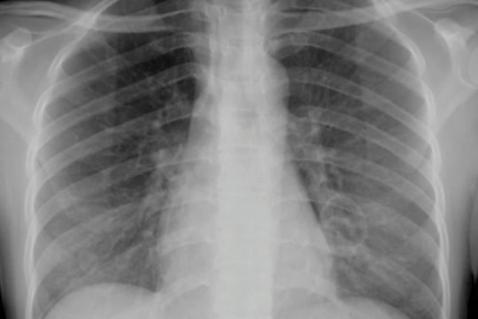 Người phụ nữ 33 tuổi nhiễm vi khuẩn 'ăn thịt người' nguy kịch