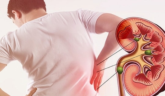 6 nguyên nhân gây sỏi thận nhiều người mắc phải