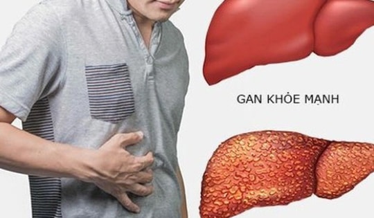 Gầy sút 5 kg trong 1 tháng, người đàn ông đi khám bất ngờ phát hiện ung thư gan