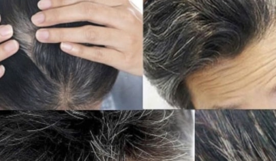 Làm thế nào để hạn chế tóc bạc sớm?