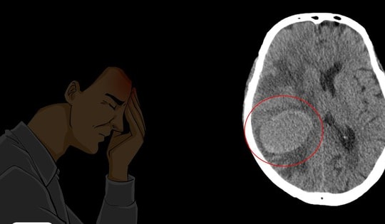 Thấy yếu nửa người, người đàn ông ở Phú Thọ đi khám và bất ngờ phát hiện bị ung thư phổi giai đoạn cuối