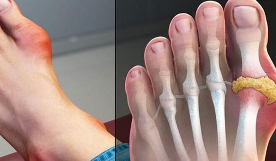 Điều trị bệnh gout cần lưu ý 3 điều sau