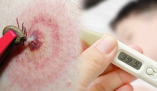 2 người bị suy hô hấp, tổn thương gan thận nặng vì sốt mò mà không biết