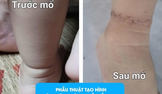 Có ngấn ở chân, bố mẹ ở Phú Thọ tưởng con bụ bẫm, nào ngờ đi khám phát hiện dị tật bẩm sinh