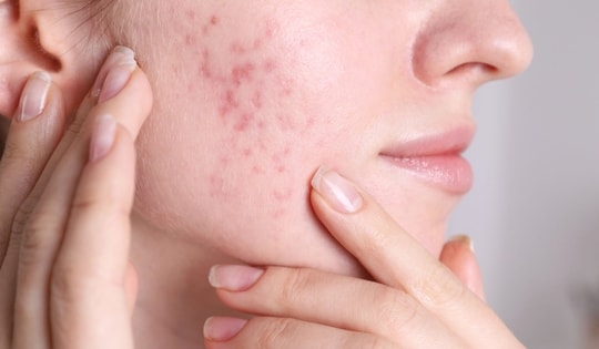 6 vitamin và thực phẩm bổ sung tốt nhất trị mụn trứng cá