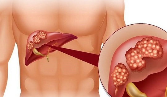 Dấu hiệu nhận biết viêm gan C