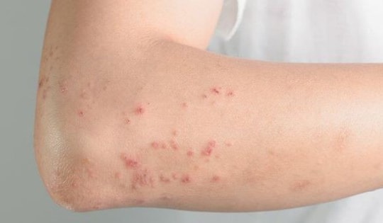 Dấu hiệu nhận biết sốt phát ban dạng sởi