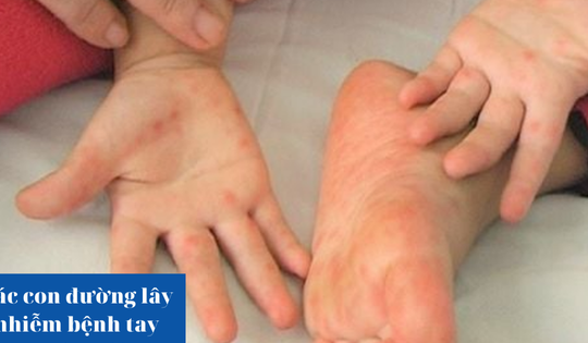 Các con đường lây nhiễm bệnh tay chân miệng là gì?