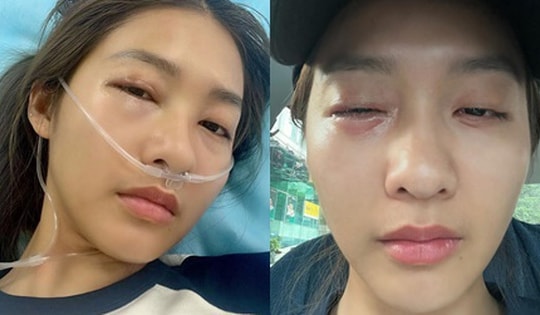 Khả Ngân bị sốc phản vệ, dung mạo hiện tại khó nhận ra