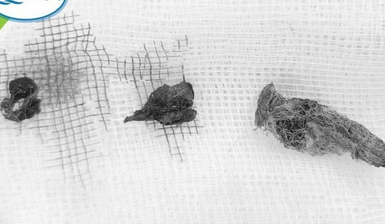 Bé gái 5 tuổi bị viêm nhiễm tái phát, đi khám bất ngờ phát hiện nhiều dị vật trong vùng kín