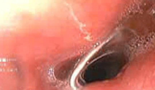 Vô tình nuốt dị vật niềng răng khi uống nước, bé gái 11 tuổi được nôi soi gây mê khẩn