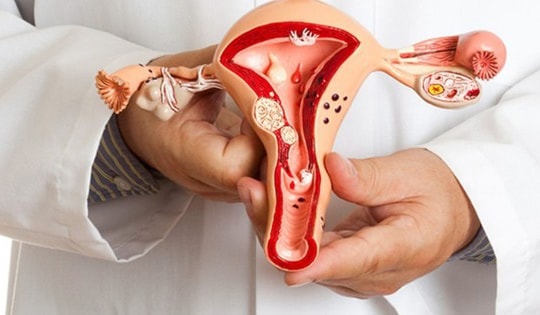 Các dạng u nang buồng trứng hay gặp, có nguy hiểm?