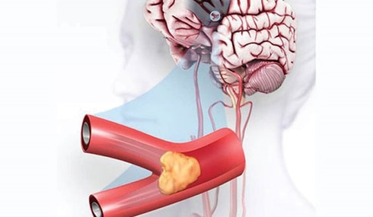 Biện pháp giảm nguy cơ thiếu máu lên não