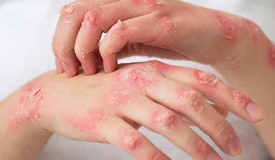 Người viêm da cơ địa nên và kiêng ăn gì để tránh bệnh trở nặng?