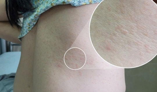 Sẩn ngứa khắp người, người phụ nữ 51 tuổi ở Phú Thọ đi khám bất ngờ dương tính với giun đũa chó mèo