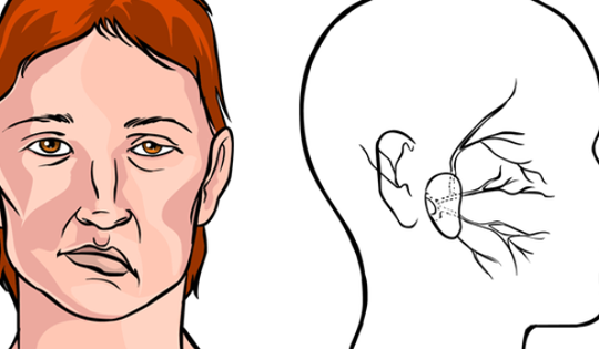 Thường xuyên làm những điều này trong lúc giao mùa, gia tăng nguy cơ liệt dây thần kinh số 7
