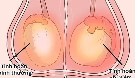 Bài tập tốt nhất cho người bệnh viêm tinh hoàn