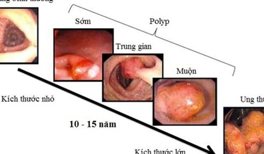 Người đàn ông ở Phú Thọ phát hiện mắc ung thư trực tràng từ một dấu hiệu nhiều người Việt bỏ qua