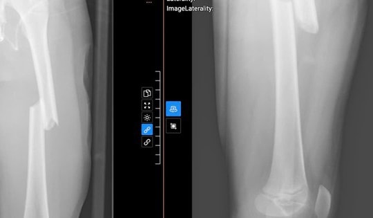 Bệnh nhi 7 tuổi gãy xương đùi phức tạp
