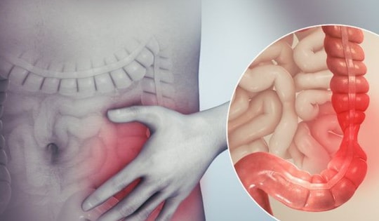 Uống mấy tách cà phê mỗi ngày giúp giảm nguy cơ tái phát ung thư ruột?