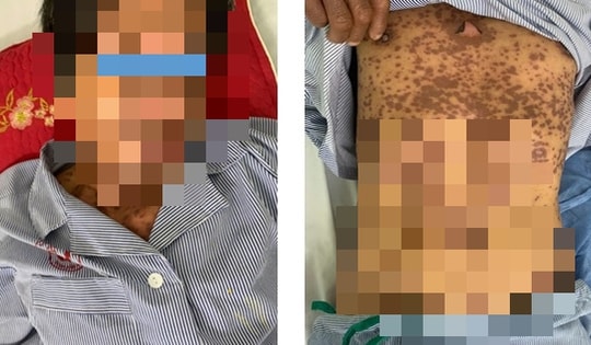 Uống thuốc trị nhiệt miệng, người đàn ông đi cấp cứu trong tình trạng lở loét toàn thân