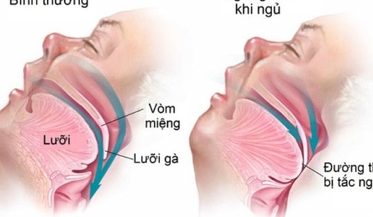 Hay buồn ngủ ban ngày, ngủ ngáy, mệt mỏi khi thức dậy, cần lưu ý hội chứng nguy hiểm này