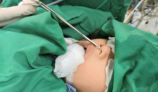 Bé trai 4 tuổi ở Bắc Giang có răng mọc ở… mũi