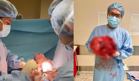 Thai nhi chào đời khoẻ mạnh trong khối u xơ nặng 8kg