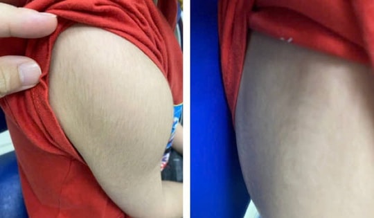 Con bị suy tuyến thượng thận do thói quen nhiều người lớn hay mắc phải