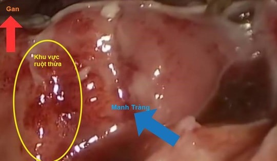 Đau bụng âm ỉ, đau bụng quanh rốn cảnh giác với viêm ruột thừa