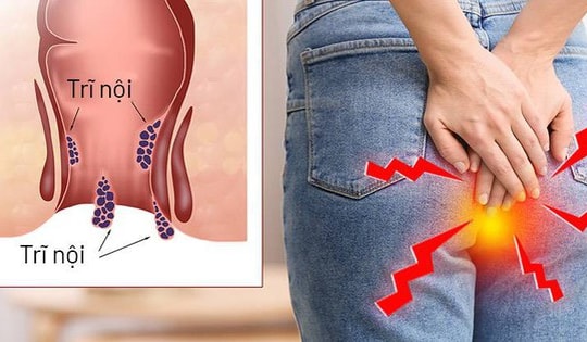 Thanh niên 27 tuổi ở Quảng Ninh bị hoại tử tầng sinh môn thừa nhận một sai lầm nhiều người Việt mắc phải