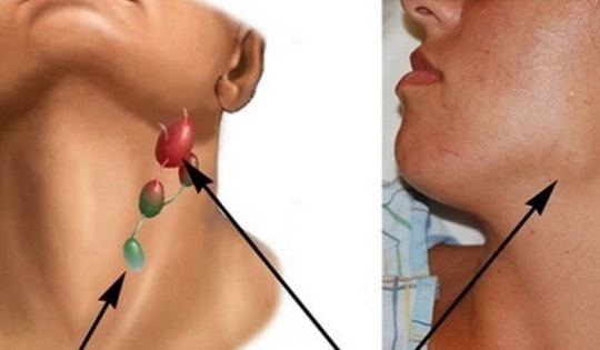 Đi mát-xa, người phụ nữ ở Yên Bái bất ngờ phát hiện dấu hiệu ung thư hạch, ai có dấu hiệu này cần cảnh giác!