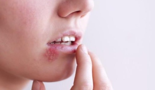 Bệnh mụn rộp sinh dục dễ nhầm với mụn nhọt thông thường