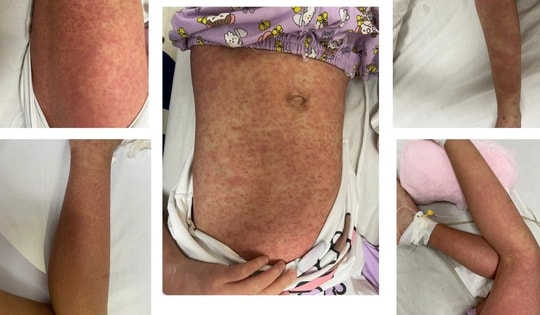 Con nổi ban toàn thân, men gan tăng cao gấp 70 lần do thói quen dùng thuốc người lớn hay mắc phải