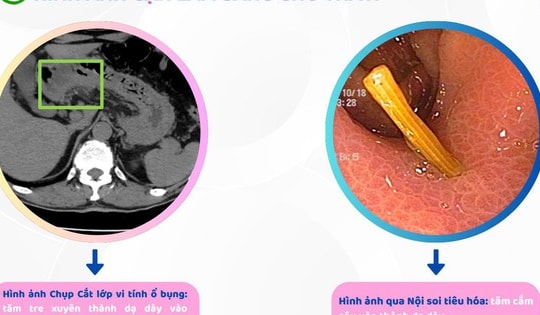 Người đàn ông ở Hải Phòng bị thủng dạ dày, thừa nhận một sai lầm mà nhiều người Việt mắc phải