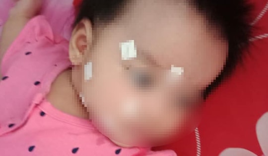 Bé gái hơn 1 tuổi ở Phú Thọ liệt dây thần kinh số 7 ngoại biên, bác sĩ chỉ rõ nguyên nhân rất hay gặp trong mùa lạnh