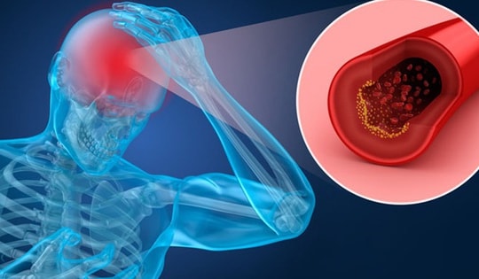 Ai dễ bị thiếu máu não?