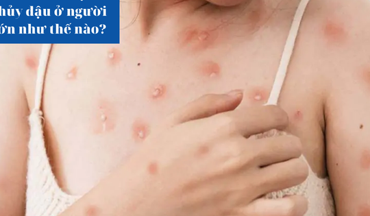 Bệnh thủy đậu ở người lớn, điều trị như thế nào?